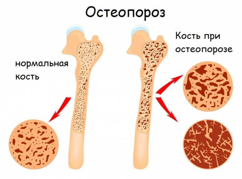 Остеопороз при дефиците витамина D
